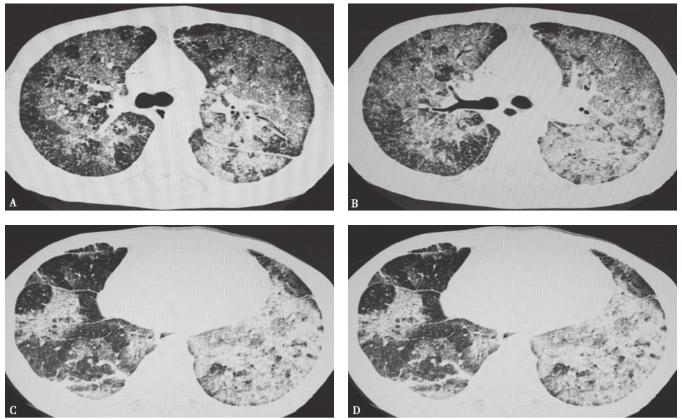 图14 复查胸部CT表现（2015-08-28）.jpg